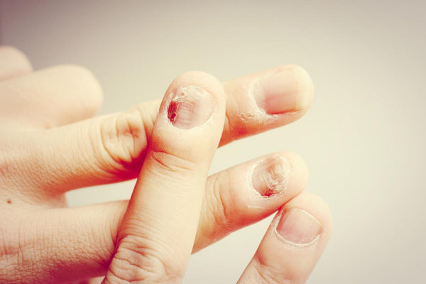 Healing Fungal Nail Infections Naturally: The Power of Allicin
